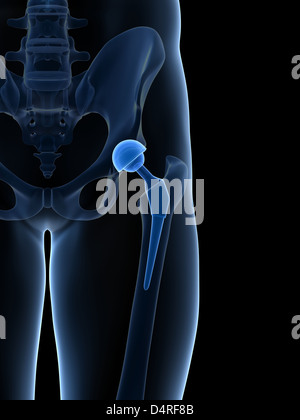 Sostituzione dell'anca Foto Stock