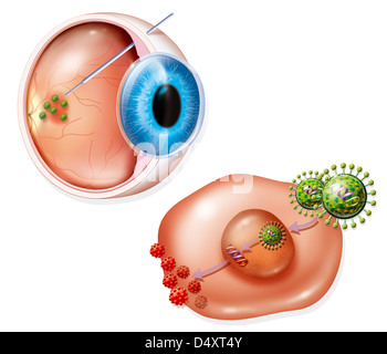 AMD Treatment, illustrazione Foto Stock