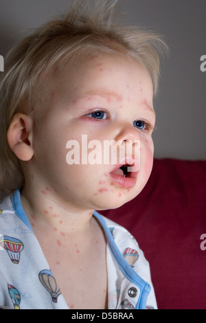 Ragazzino con la varicella Foto Stock