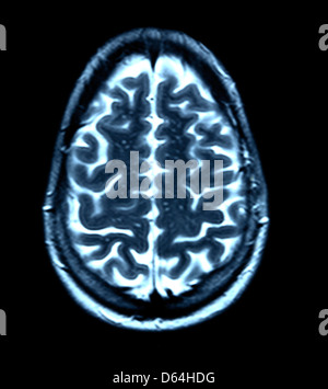 Scansione cerebrale, MRI scan Foto Stock