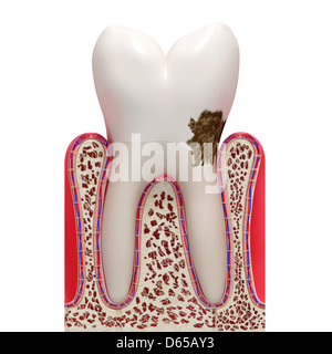 La placca dentale, artwork Foto Stock
