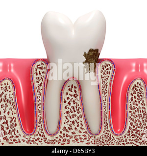 La placca dentale, artwork Foto Stock