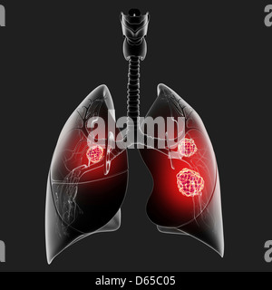 Il cancro del polmone, artwork Foto Stock