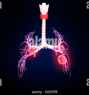 Il cancro del polmone, artwork Foto Stock