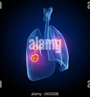 Il cancro del polmone, artwork Foto Stock