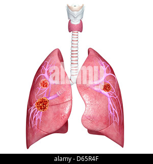 Il cancro del polmone, artwork Foto Stock