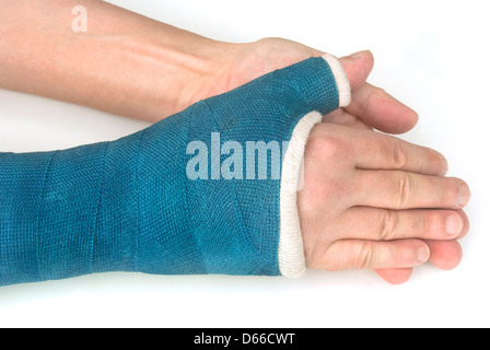 Polso rotto il braccio con un blu della fibra di vetro colato su uno sfondo bianco frattura Foto Stock