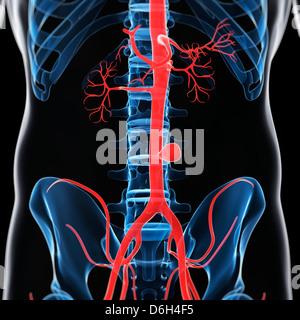 Aneurisma aortico, artwork Foto Stock