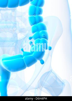 Diverticolosi, artwork Foto Stock