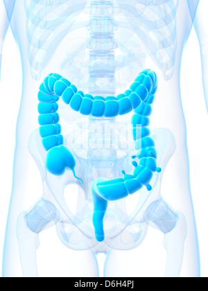 Diverticolosi, artwork Foto Stock