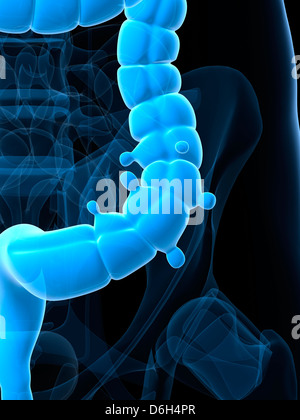 Diverticolosi, artwork Foto Stock