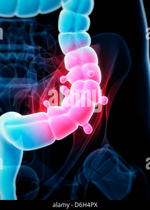 Diverticolosi, artwork Foto Stock