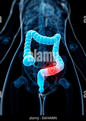 Il cancro del colon, artwork Foto Stock