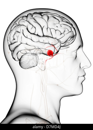 Aneurisma cerebrale, artwork Foto Stock