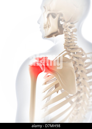 Dolore alla spalla, opere d'arte concettuale Foto Stock