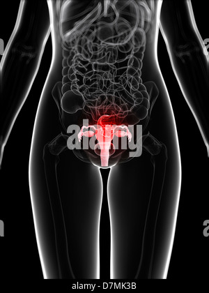 Cancro uterino, artwork Foto Stock