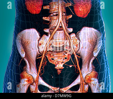 Aorta addominale, 3D CT scan Foto Stock