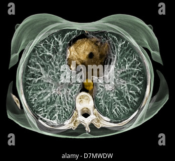 Anatomia del torace, 3D CT scan Foto Stock