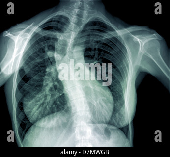 La scoliosi della colonna vertebrale, X-ray Foto Stock