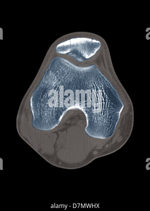 Malattia del ginocchio, la scansione TC Foto Stock