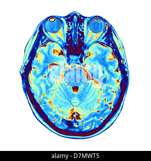 Esplorazione di MRI del cervello Foto Stock