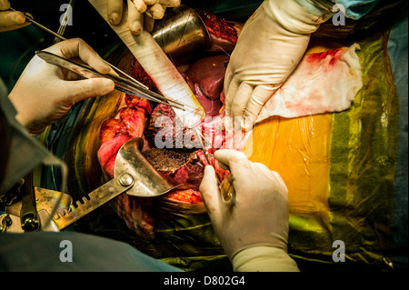 I chirurghi di eseguire un trapianto di fegato. Foto Stock