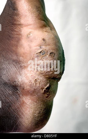 Mycetoma sul piede sinistro di un giovane maschio. Foto Stock
