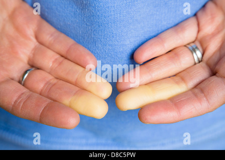 Close up dettaglio della donna con le dita di Raynaud fenomeno. Il vasospasmo limita il flusso sanguigno per le dita. Foto Stock
