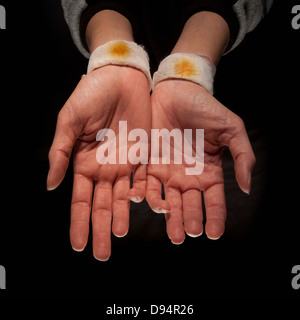 Close-up di donna con le mani in mano e macchie sui polsi bendato, Studio Shot Foto Stock