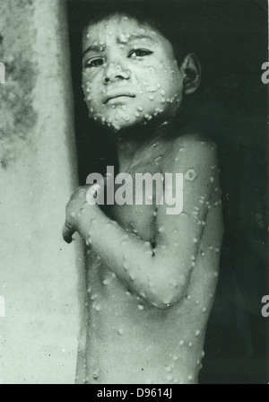 Ultimo caso indigeno del vaiolo in India, Katihar distretto, Eihar membro. Vittima, Manjo un ragazzo di 7 anni, maggio 1975. Chi fotografia. Foto Stock