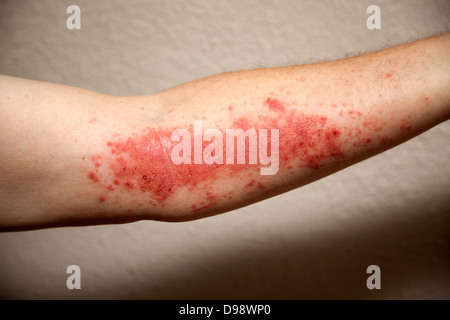 Reazione allergica a Poison Ivy Toxicodendron radicans , USA orientale Foto Stock