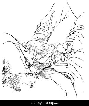 Medicina, ginecologia della nascita, nascita, disegno a matita di otto Dix (1891 - 1969), 1927, diritti-aggiuntivi-clearences-non disponibile Foto Stock