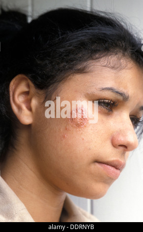 Ragazza giovane con impetigo sulla faccia Foto Stock