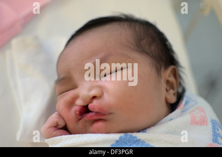 I neonati con schisi labiale e del palato dormendo. Foto Stock