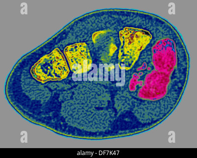 Piede fratturato, scansione Foto Stock