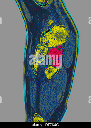 Piede fratturato, scansione Foto Stock
