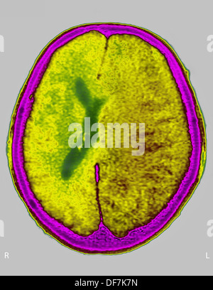 EDEMA CEREBRALE CT SCAN Foto Stock