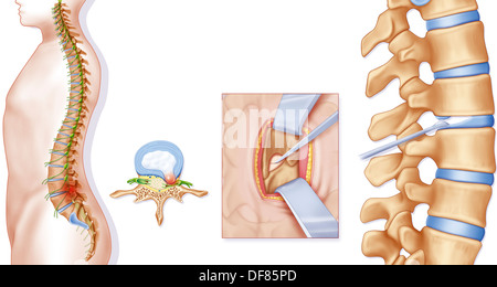 Ernia del disco, illustrazione Foto Stock