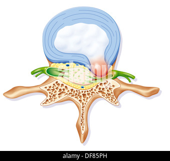 Ernia del disco, illustrazione Foto Stock