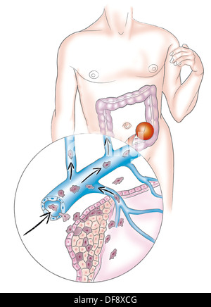 La metastasi, disegno Foto Stock
