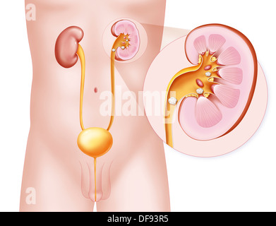 Litiasi renale disegno Foto Stock