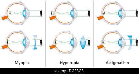 Difetti Visivi - miopia, ipermetropia e astigmatismo Foto Stock