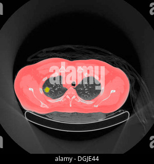 La tomografia ad emissione di positroni (PET) scansione di un maschio, 54 anno vecchio paziente. Un tumore può essere visto nella parte sinistra del lobo superiore dei suoi polmoni Foto Stock