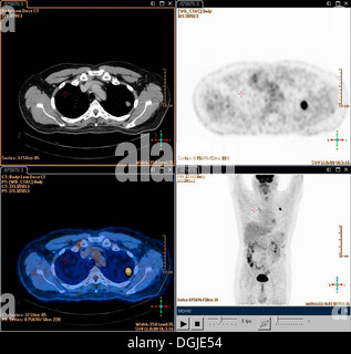 Un positrone composito insieme di emissione di positroni (PET) scansione di immagini del collo di un paziente di sesso maschile di età compresa tra i 54. Un tumore può essere visto Foto Stock