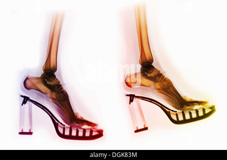 X-ray dei piedi in una coppia di tacco alto scarpe Foto Stock