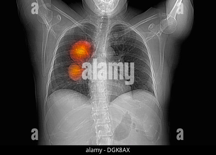 Il melanoma metastatico dei polmoni Foto Stock