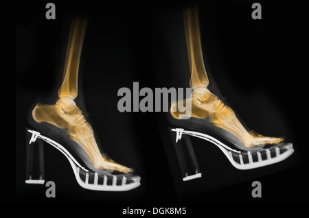 X-ray dei piedi in una coppia di tacco alto scarpe Foto Stock