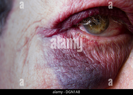 Un uomo di sessant'anni con un occhio nero con sangue raccolto dopo aver scattato su un marciapiede di Los Angeles in necessità di riparazione Foto Stock