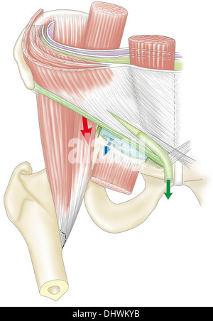 Ernia inguinale, disegno Foto Stock