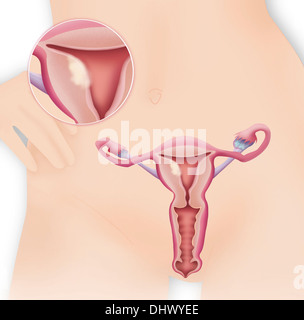 Il cancro endometrio, disegno Foto Stock